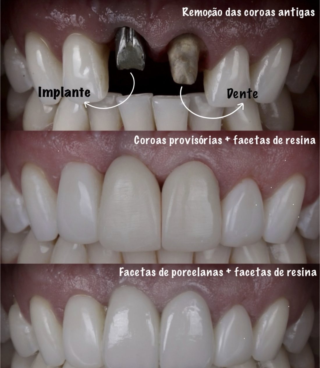 Remoção de coroas antigas, provisórias e facetas finais