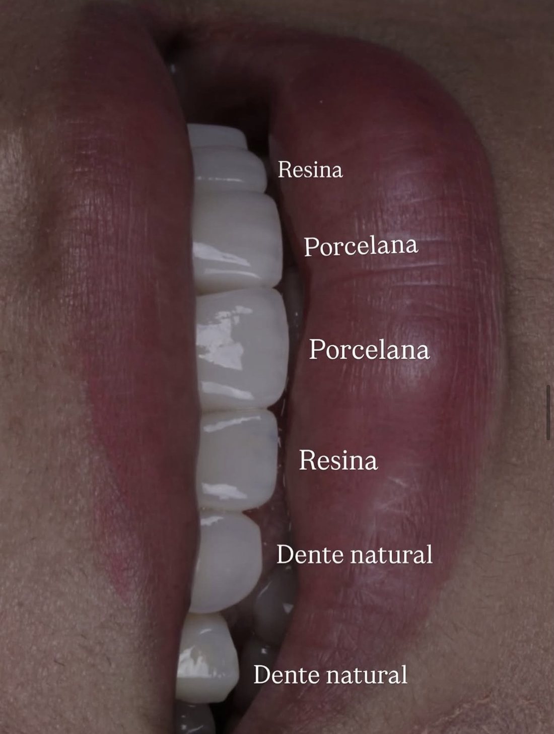 Sorriso com resina, porcelana e dentes naturais lado a lado