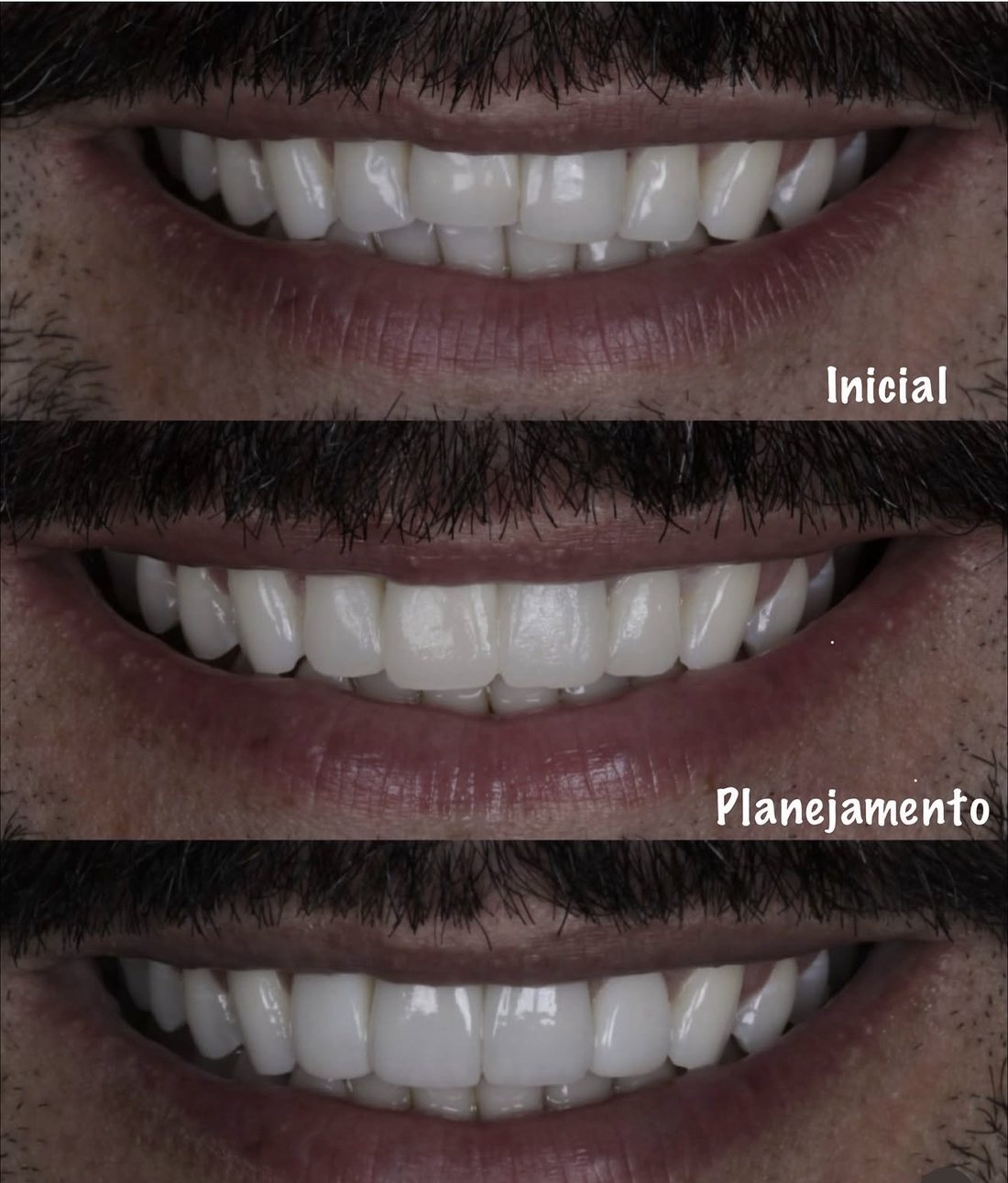 Sorriso inicial, planejamento e resultado final