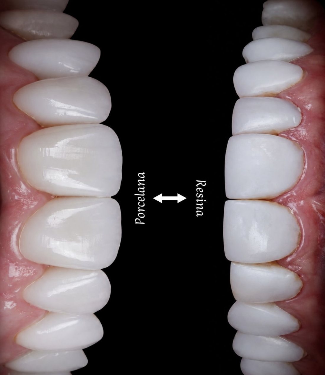 Comparação entre facetas de porcelana e de resina