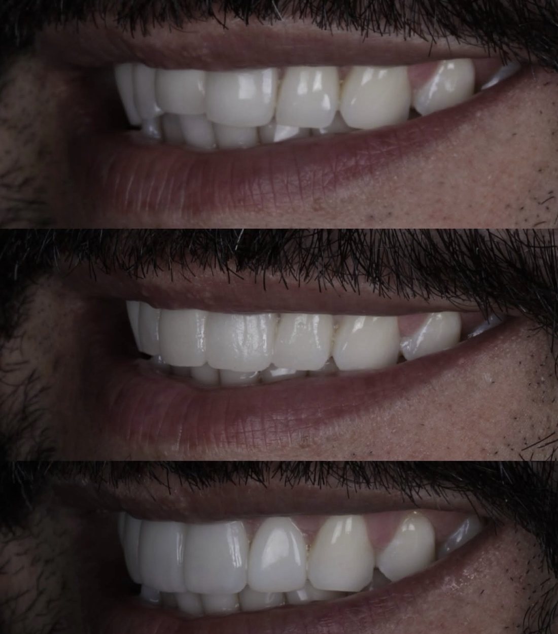 Evolução de um sorriso em três etapas